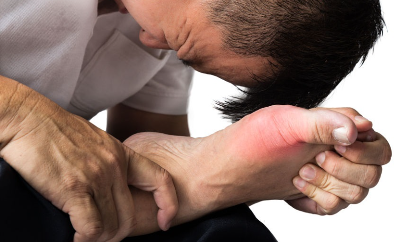 gout-physio-treatment